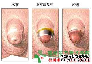 包皮过长包茎会引起早泄吗？