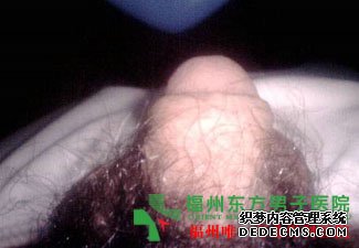 龟头脱皮是怎么回事? 龟头脱皮是怎么回事?