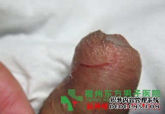 福州龟头长肉粒怎么办?