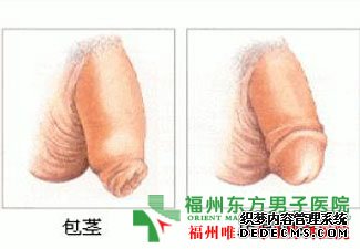 怎么有效治疗龟头炎?