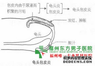 龟头痒有红斑竟然都是龟头炎惹得祸