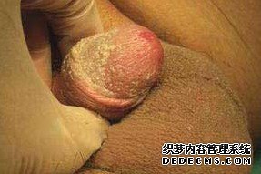 包皮龟头炎有哪些症状？该如何治疗？