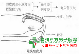 包皮溃烂应该怎么办? 包皮溃烂应该怎么办?