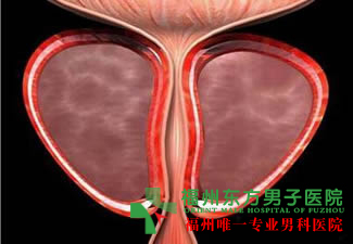 什么是精索静脉曲张？
