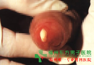小便尿道口刺痛是怎么回事