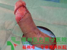 男性精子畸形会导致哪些危害？