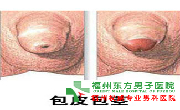 假性包皮过长是怎么回事?