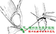 什么是包茎?