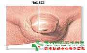 包皮嵌顿是什么?