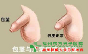 包皮包茎手术?