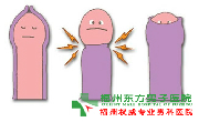 欧式包皮手术?