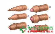 包皮手术价格?