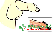 包皮过长原因?