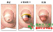 包皮白点?