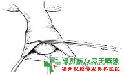 包皮与不育的关系