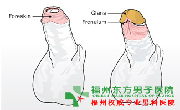 包皮肿原因