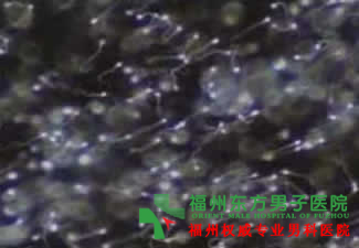 男性精子不液化会有哪些症状