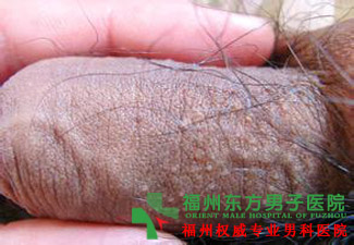 男性尿道炎怎么治疗