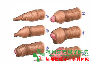 包皮过长可以不割吗?