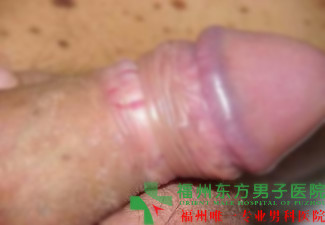 怎么有效治疗龟头炎?